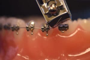 Clipping a braces wire with fingernail clippers