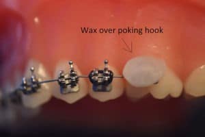 How to add wax over a poking braces hook