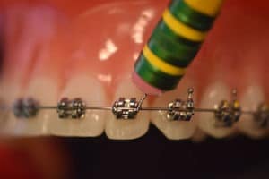 Using a pencil eraser to move a poking braces wire