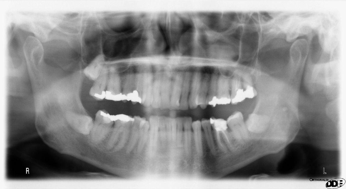 Can Orthodontics Fix Facial Asymmetry?