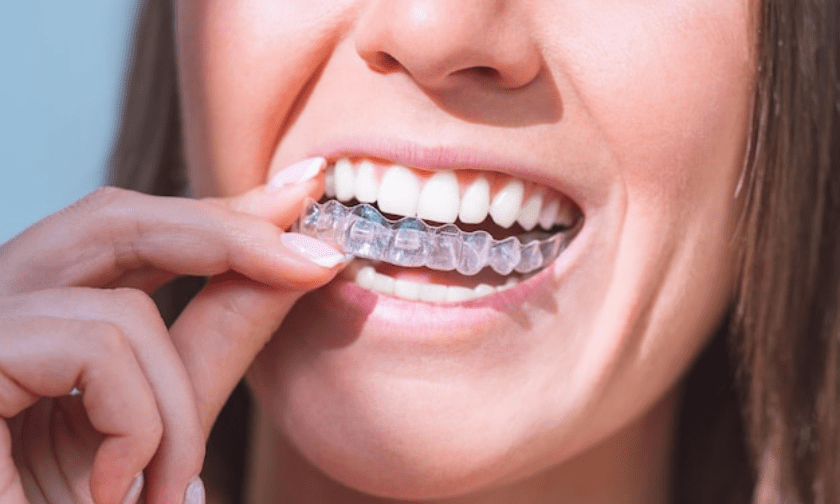 Invisalign
