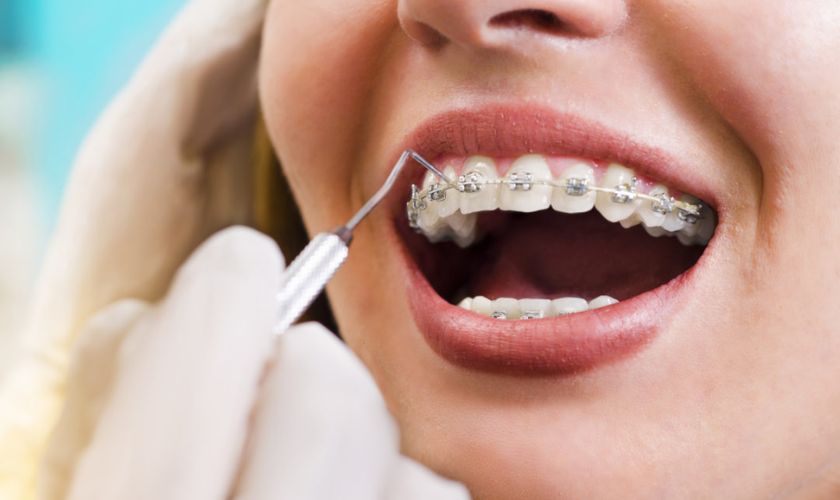 Metal Braces in Hillsboro