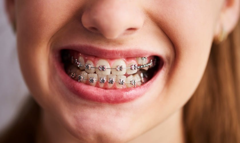 Young person smiling with metal braces on teeth, close-up portrait view.