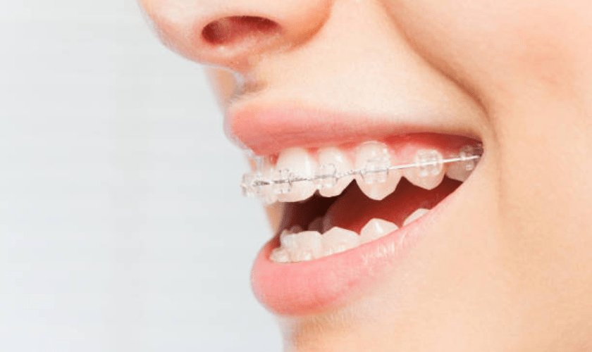 Braces