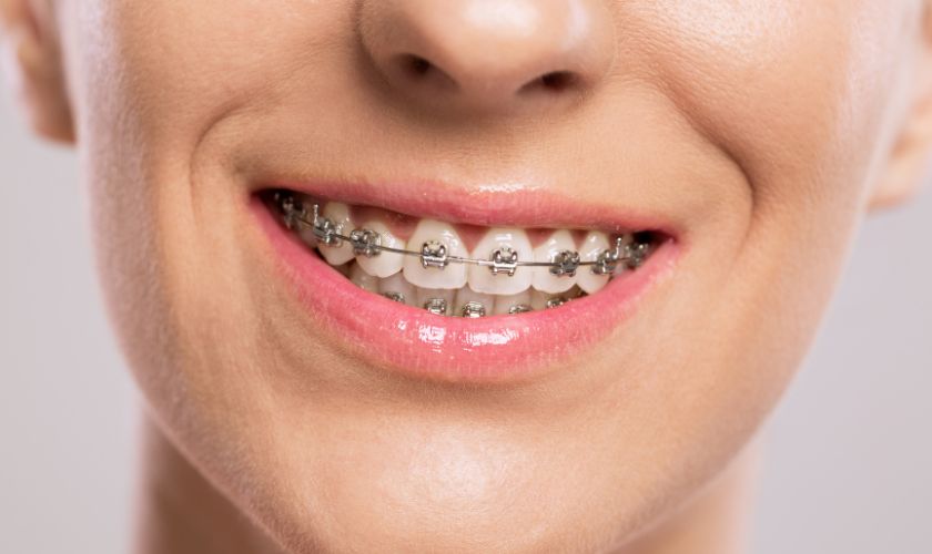 Metal Braces | Braces Hillsboro | Laidlaw Orthodontics