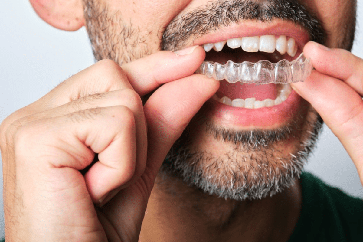 Invisalign Timeline: How Long Does It Take to Work?