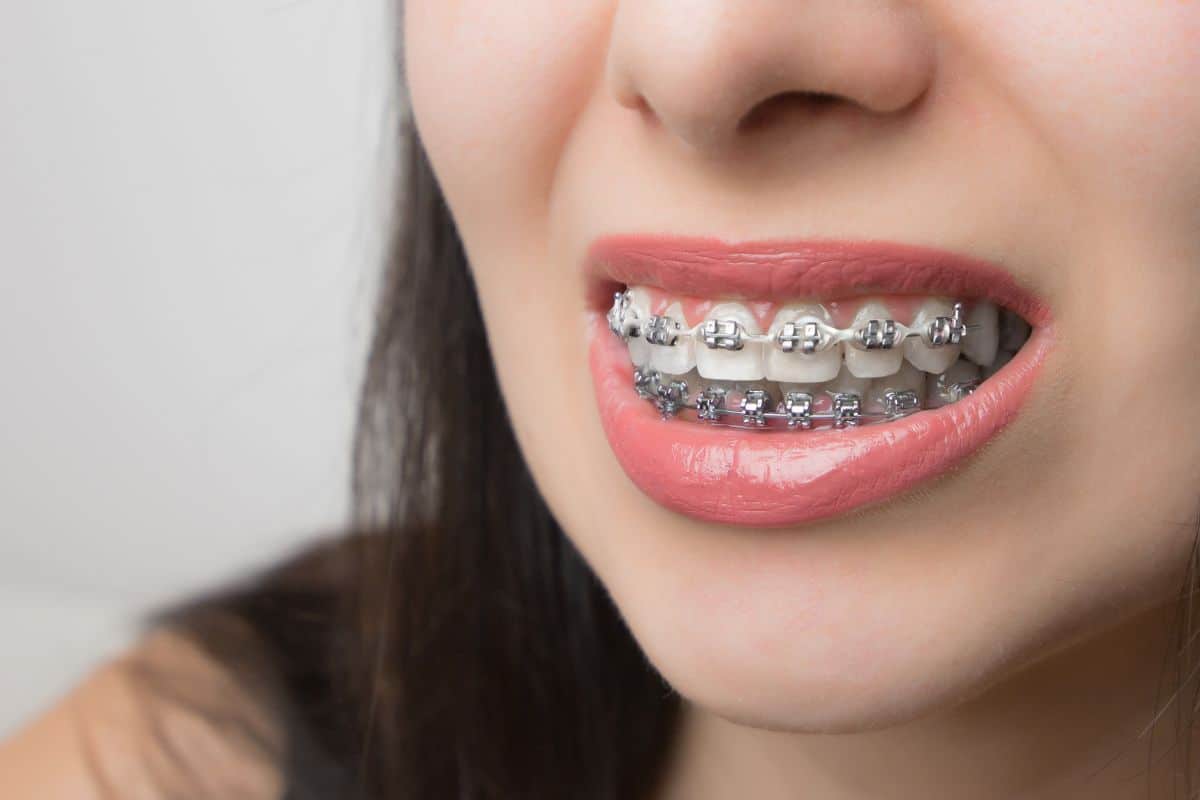 What To Do When Braces Feel Too Tight?