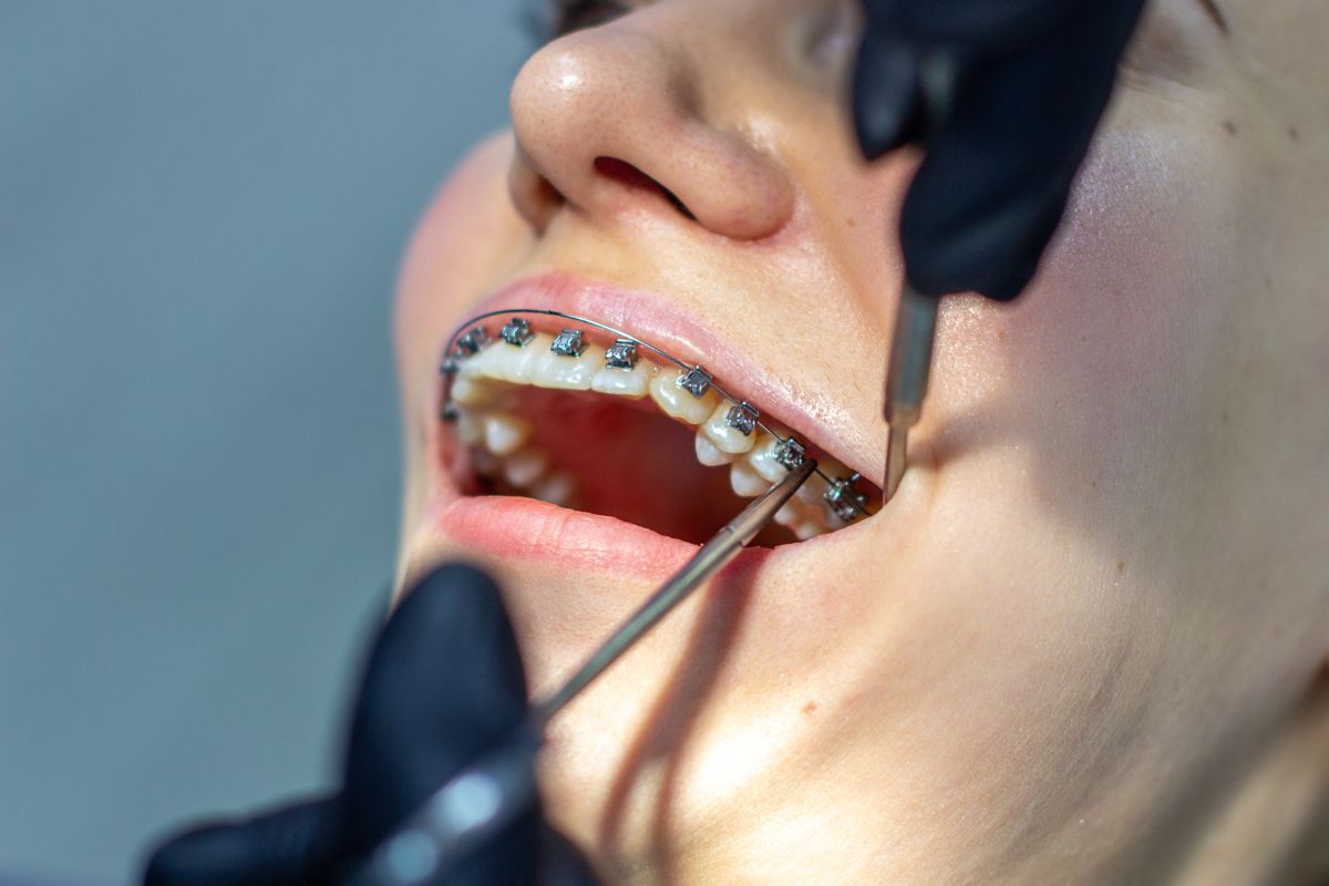 Orthodontist fixing braces on female patient