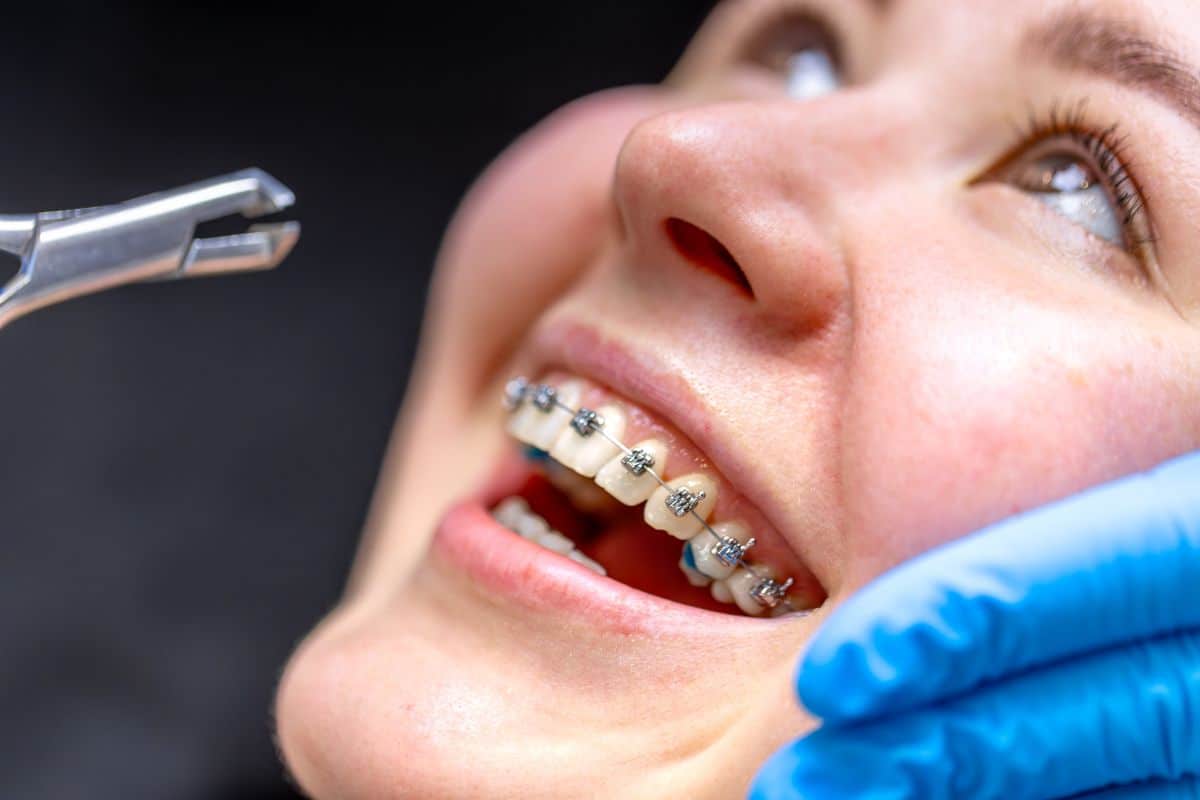 Braces on teeth during dental checkup close-up