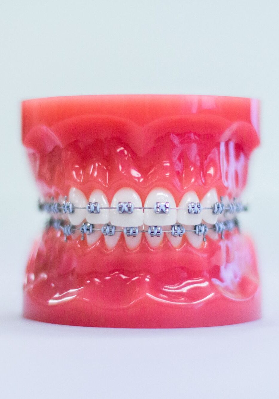 Metal Braces Hillsboro